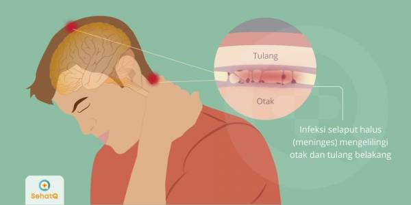 Mengenal Meningitis: Gejala, Penyebab dan cara Pencegahannya